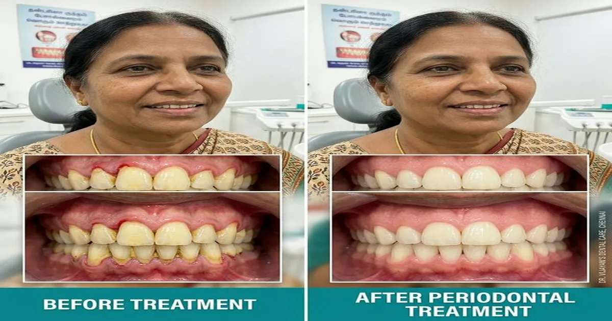 Before and after periodontal treatment showing restored gum health and saved teeth in Chennai patient